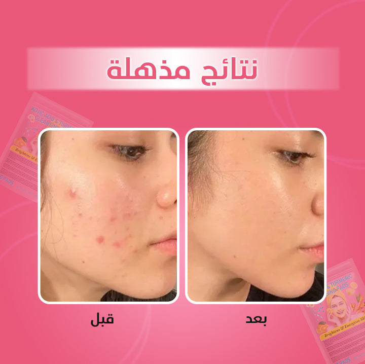 Turmeric and Kojic Acid Pads
