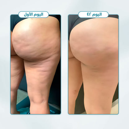 مجموعة تخفيف السيلوليت